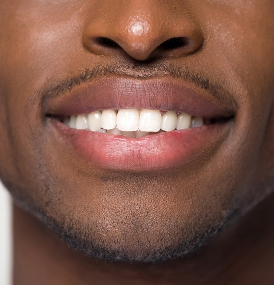 Closeup of beautiful smile after dental bonding in Denison