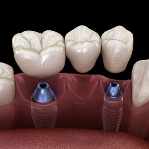 computer illustration of an implant-retained bridge