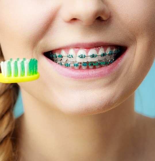 young girl’s smile with braces and yellow toothbrush