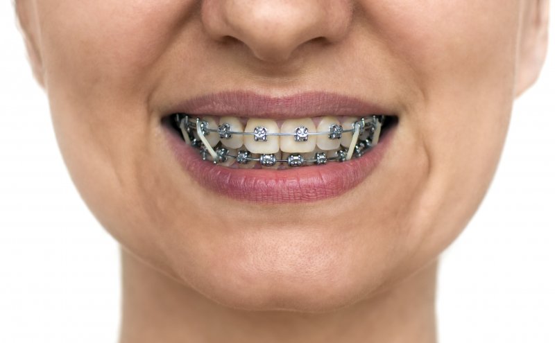 How important is wearing rubber bands with braces?